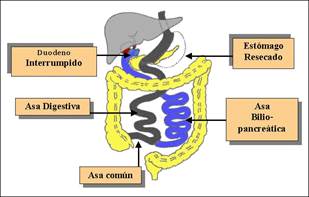 http://www.cirugiadelaobesidad.info/imagenes/derivacion_biliopancreatica/cruce_duodenal_gr.jpg